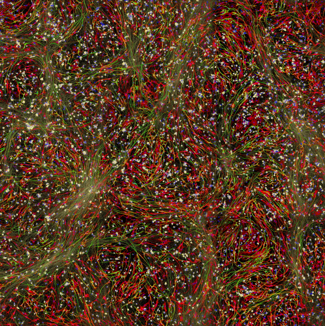 Could the brain’s over-eager ‘pruning shears’ be causing schizophrenia?