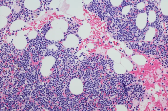 Tecvayli tops standard drugs in early multiple myeloma, J&J says