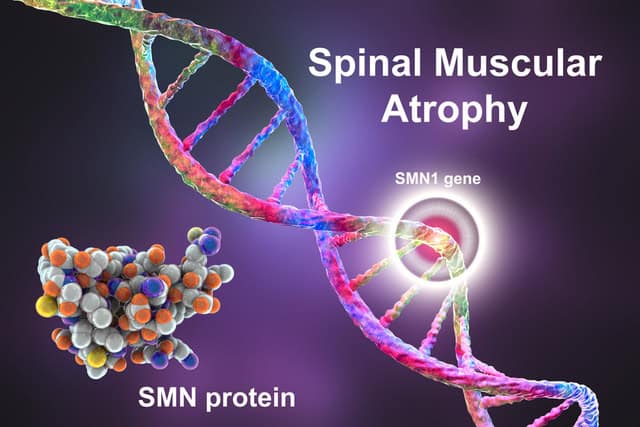 Rare diseases – spinal muscular atrophy