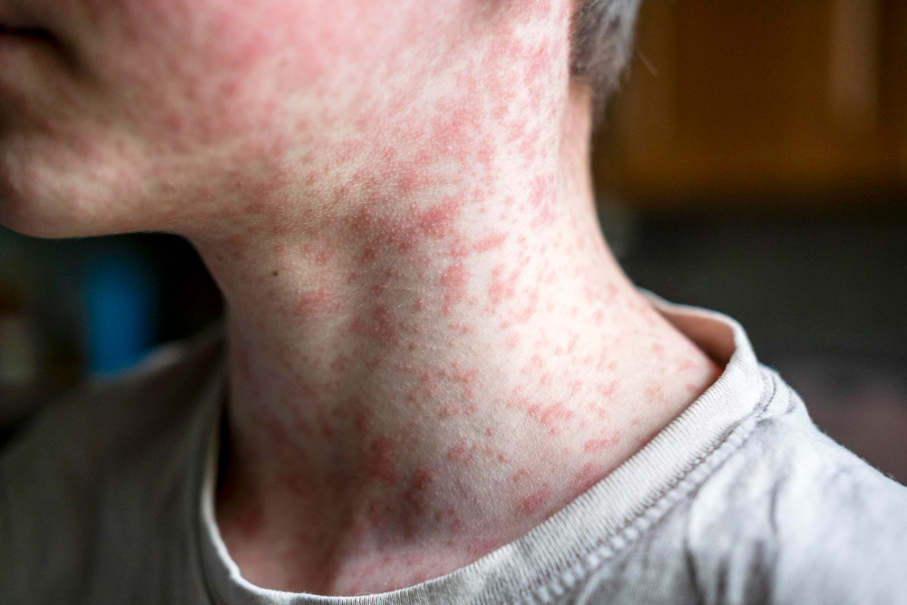 UK Measles Outbreak: What Parents in England, Wales and Scotland Need to Know