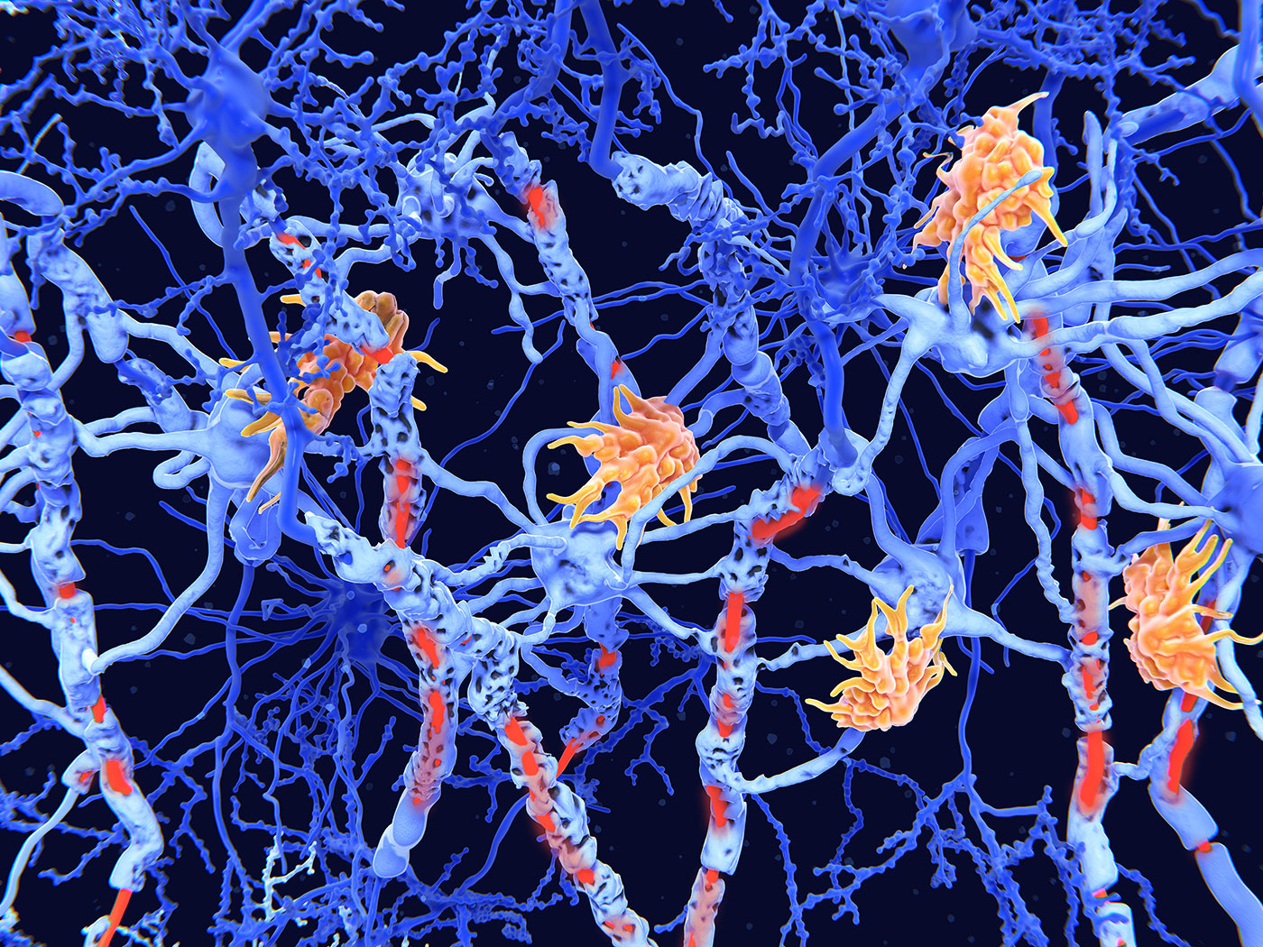 Gut-Immune Link Identified in Multiple Sclerosis-Related Neuroinflammation