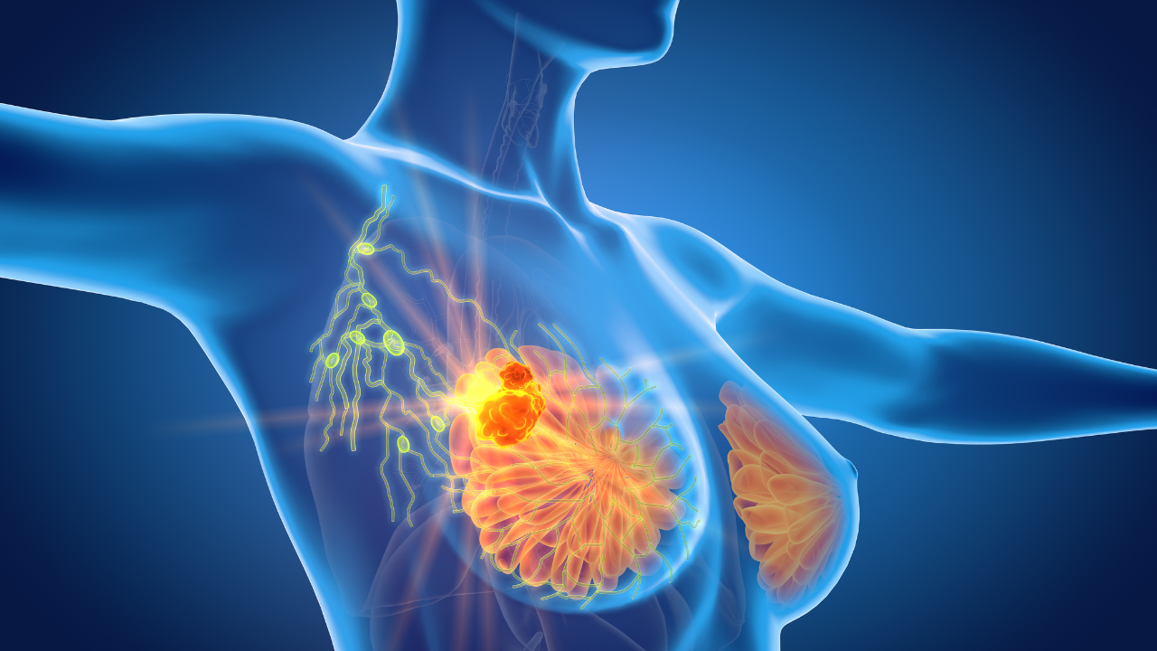 <![CDATA[FDA Approves Datroway for Patients with Metastatic Triple-Negative Breast Cancer Who Are Not PD-1/PD-L1 Inhibitor Candidates]]>