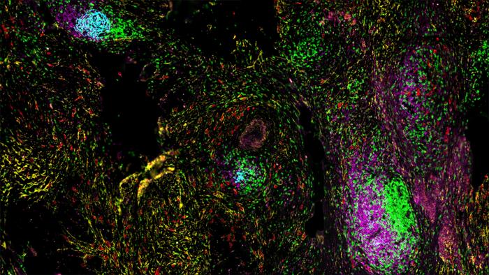 AI-Powered Pan-Cancer Map Reveals Tertiary Lymphoid Structures